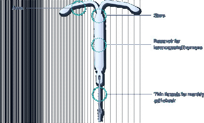 Mirena IUD in Bradenton, FL | Birth Control in South Bradenton, FL